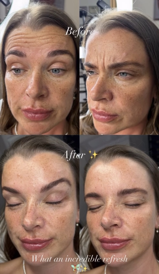 Anti-wrinkle treatment before and after