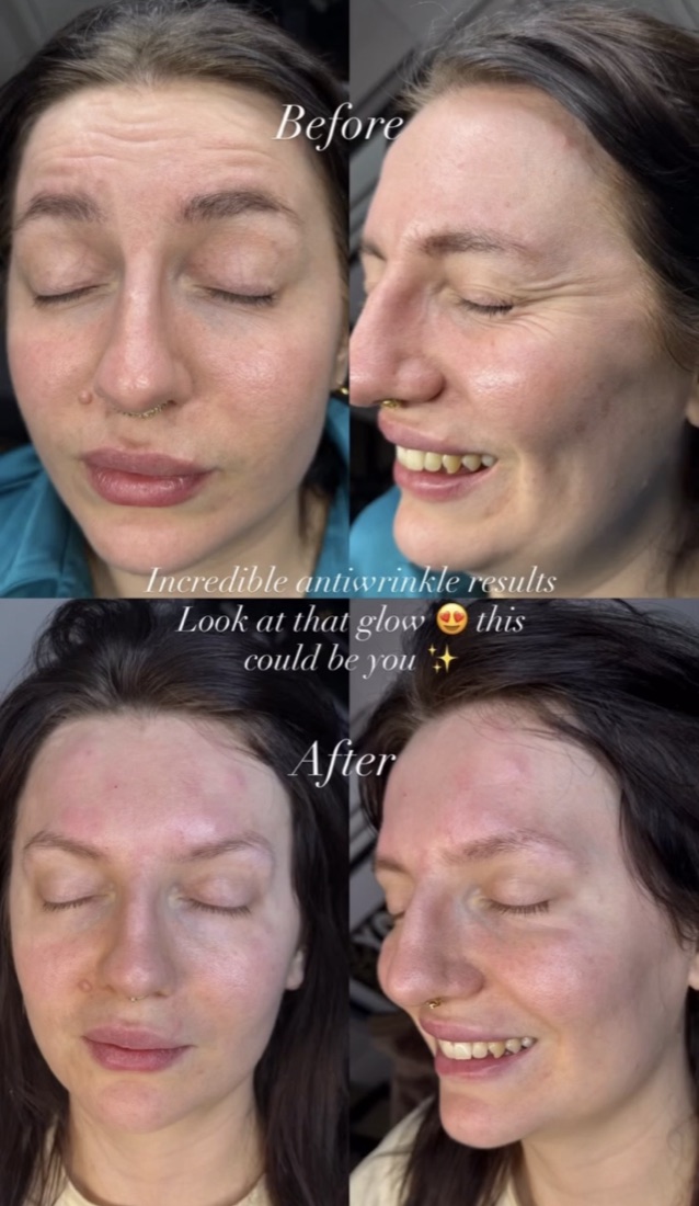 Anti-wrinkle refresh before and after