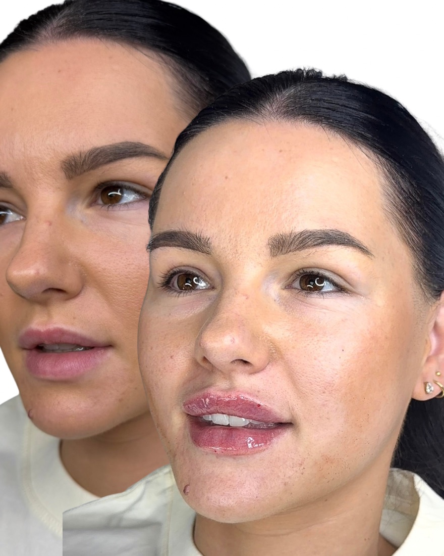 Lip filler before and after result