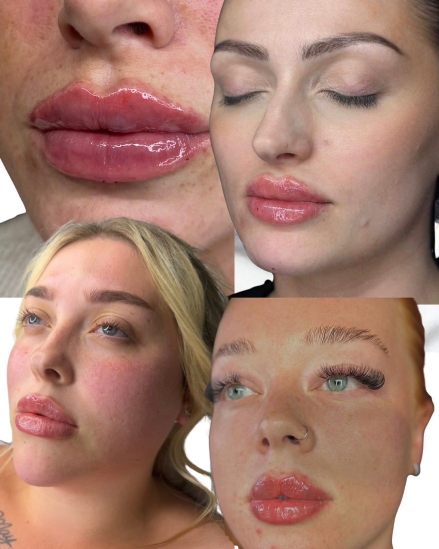 Lip enhancement results
