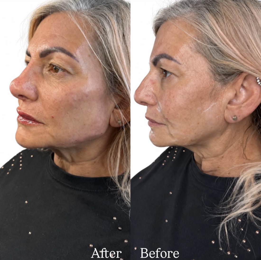 Skin rejuvenation before and after